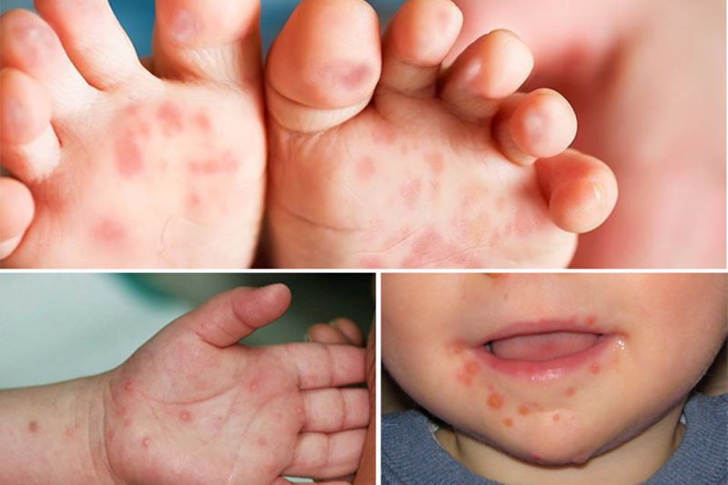 Nổi mụn nước, lở loét ở nhiều vị trí là triệu chứng điển hình của tay chân miệng